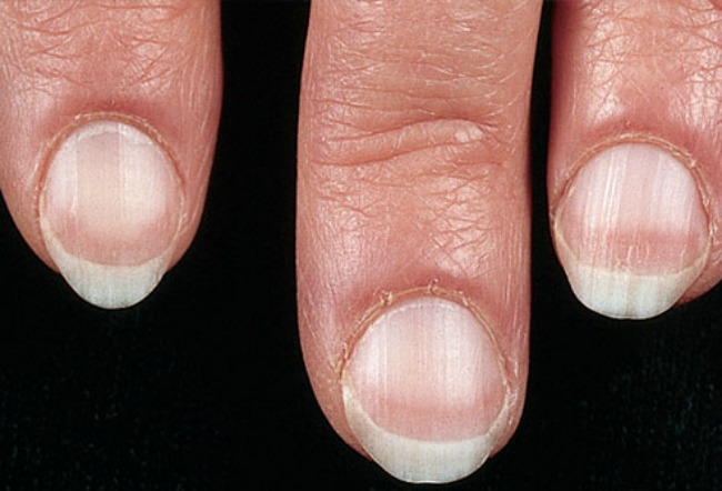 lepota i zdravlje kako nokti govore o vasem zdravlju bledi nokti Lepota i zdravlje: Šta vaši nokti govore o vašem zdravlju? 