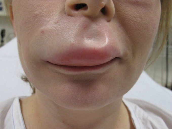 punjenje usana 4 Razlozi za i protiv povećanja usana