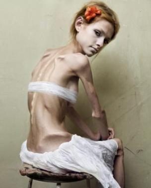 10 najšokantnijih kampanja protiv anoreksije